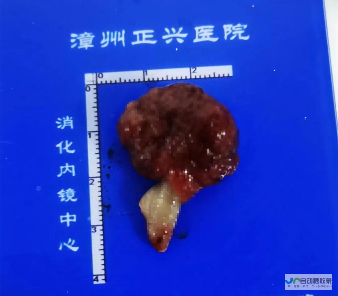 便血误判背后的隐患 痔疮与肠癌的辨识要点